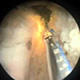 ho laser application